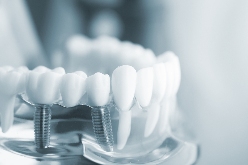 TƯ VẤN SAU KHI CẤY GHÉP RĂNG IMPLANT?