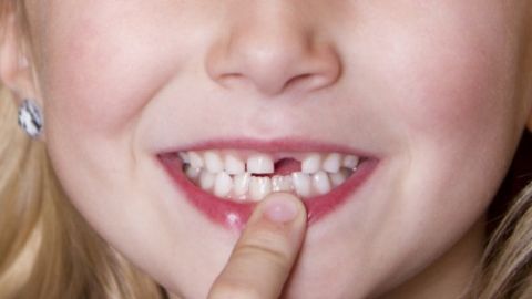 Trồng răng xứ có hôi miệng không?