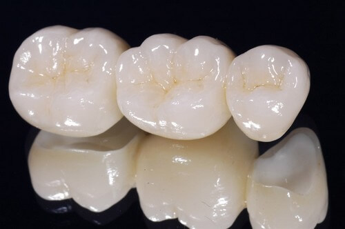 ƯU ĐIỂM CỦA RĂNG SỨ CERCON, TITAN