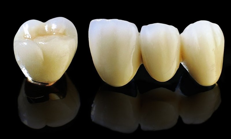 Răng xứ kim loại Cobalt